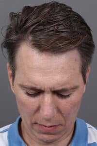 DHI Hair-Transplantation System for Men in Washington D.C.