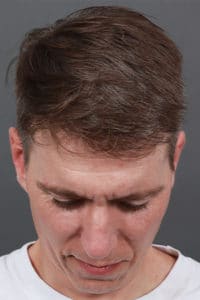 DHI Hair-Transplantation System for Men in Washington D.C.