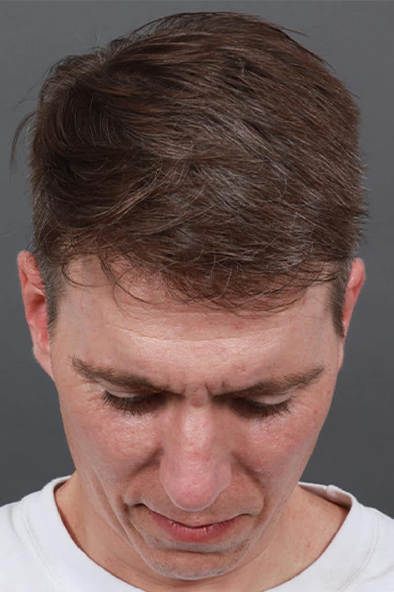 After Image: Male NeoGraft - front