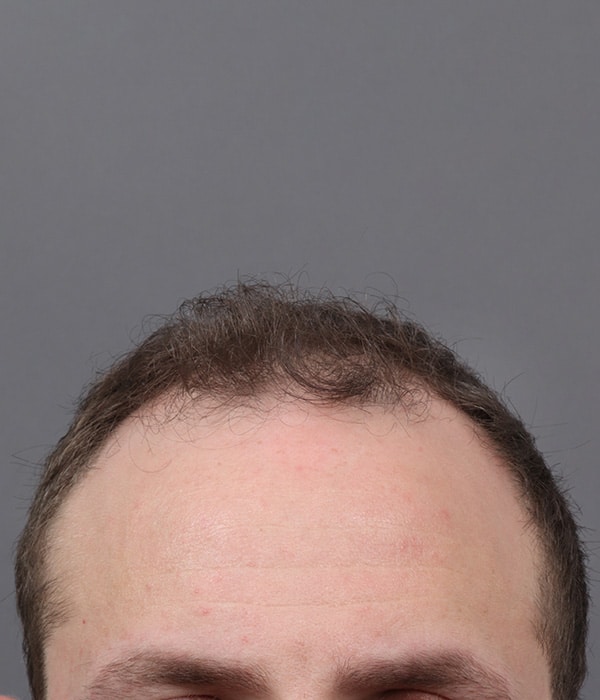 Before Image: Male NeoGraft - front