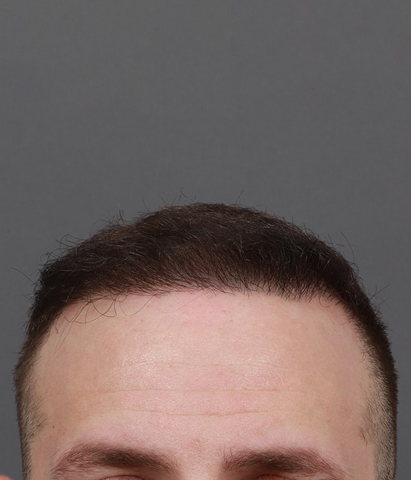 After Image: Male NeoGraft - front