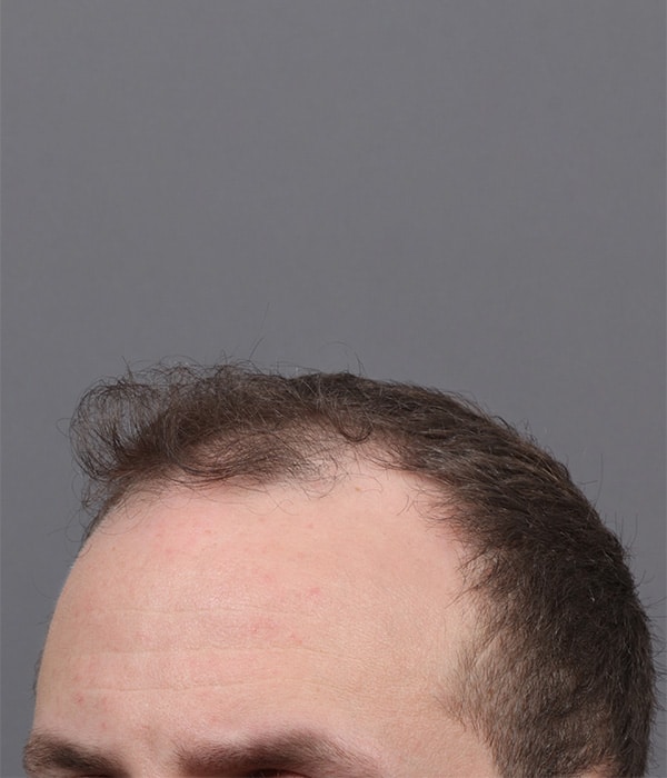 Before Image: Male NeoGraft - left-front-oblique