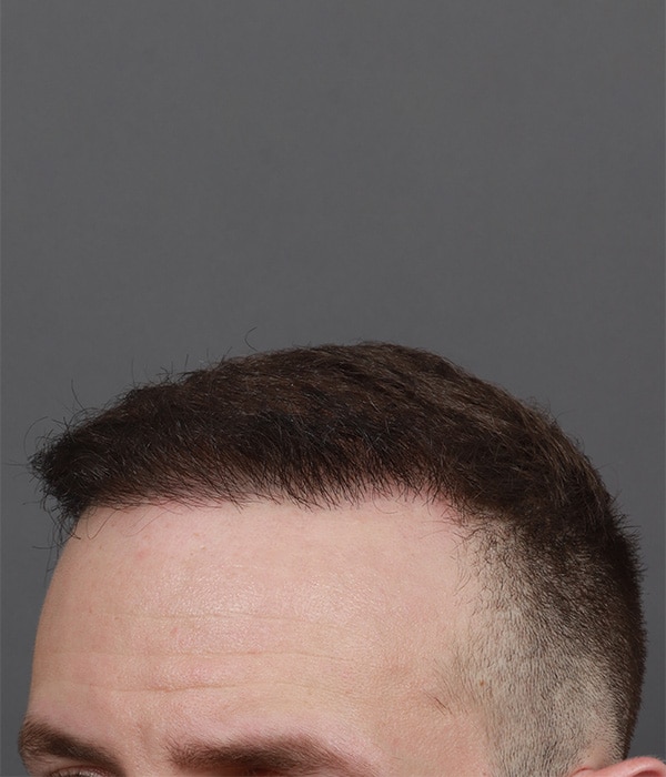 After Image: Male NeoGraft - left-front-oblique