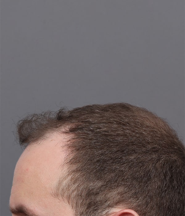Before Image: Male NeoGraft - left-side