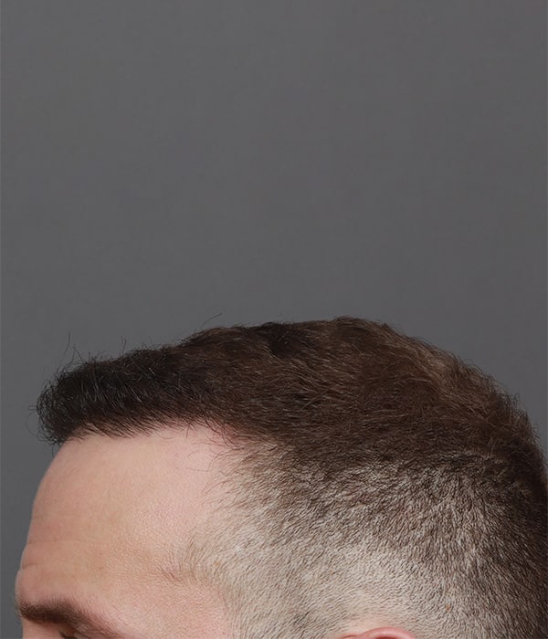 After Image: Male NeoGraft - left-side