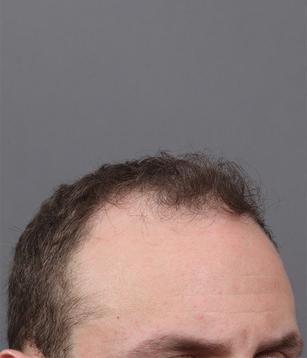 Before Image: Male NeoGraft - right-front-oblique