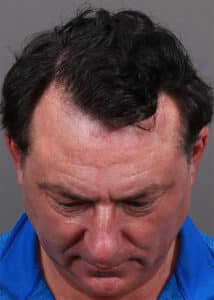 Before Image: Male NeoGraft