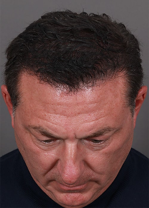After Image: Male NeoGraft - front