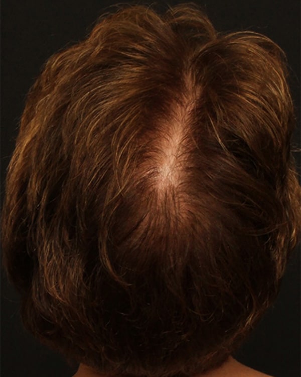 After Image: Female NeoGraft - back