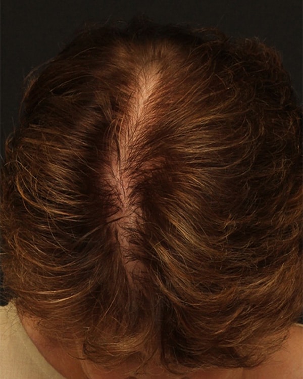 After Image: Female NeoGraft - front