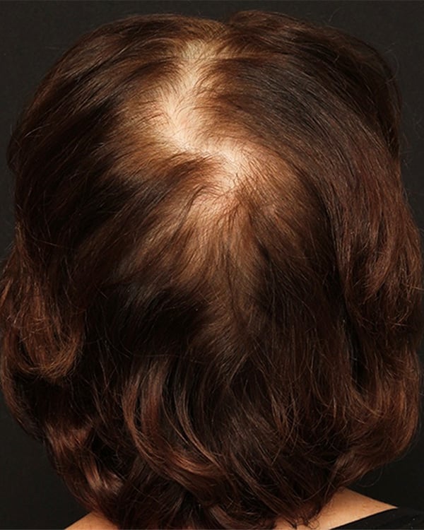 Before Image: Female NeoGraft - back
