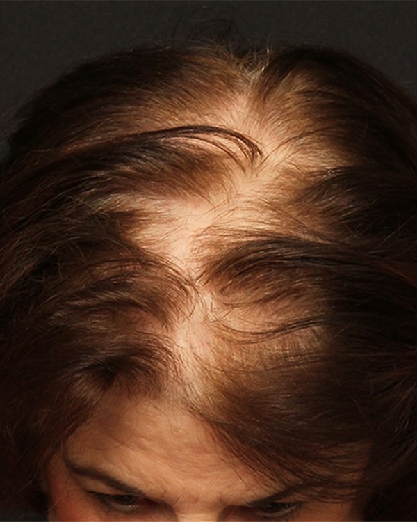Before Image: Female NeoGraft - front