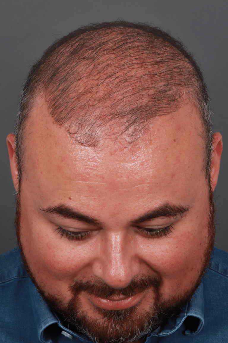 Before Image: Male DHI - front