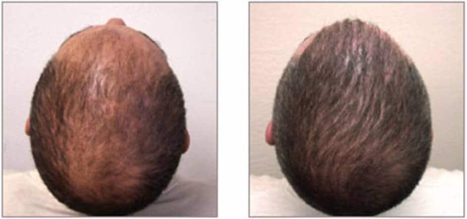 Results of the DHI Hair-Transplantation System in Washington D.C.