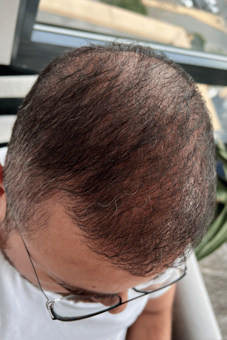 After Image: Male NeoGraft - front