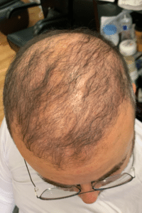 Before Image: Male NeoGraft