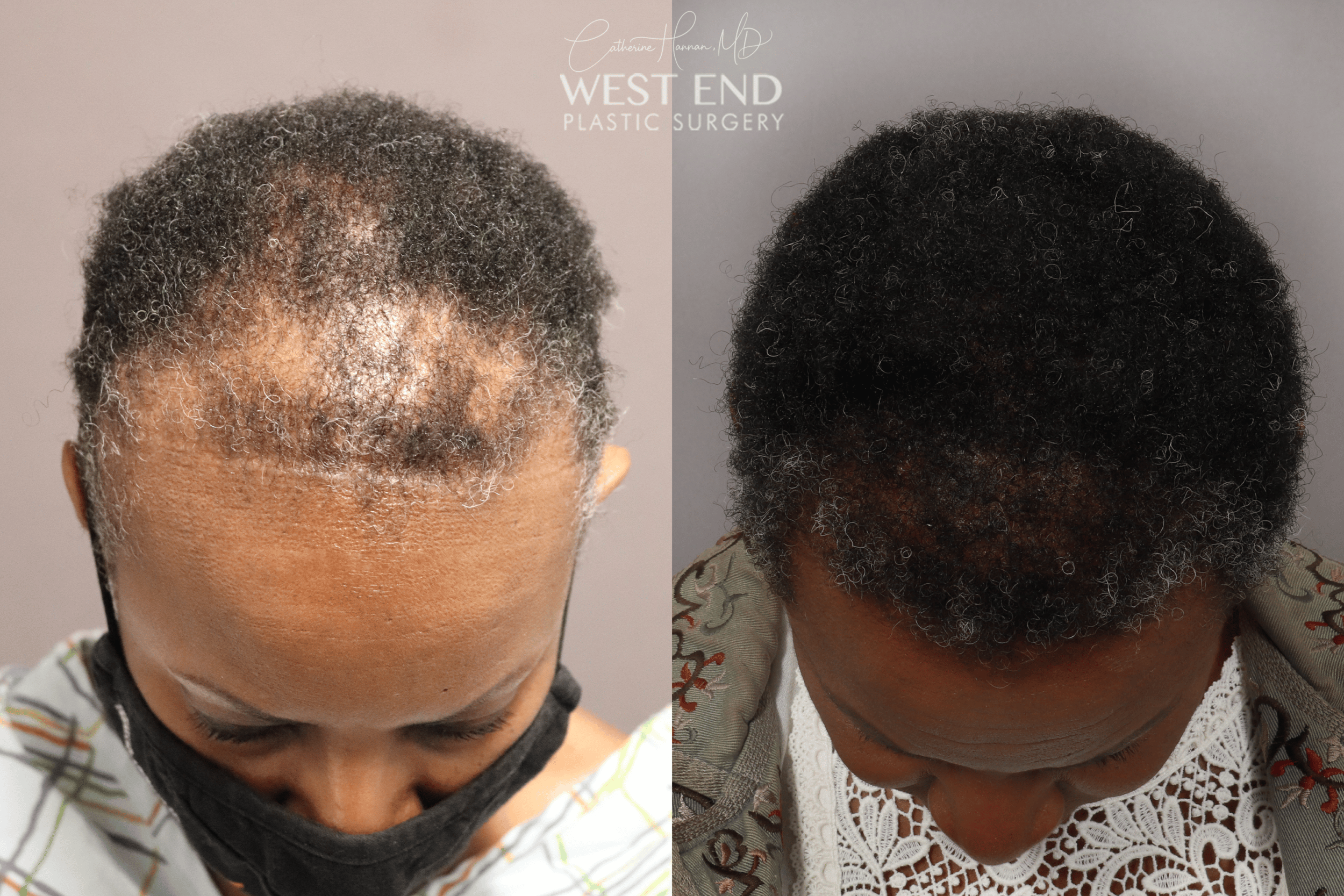 Female Hair Loss Treatment in Washington D.C.