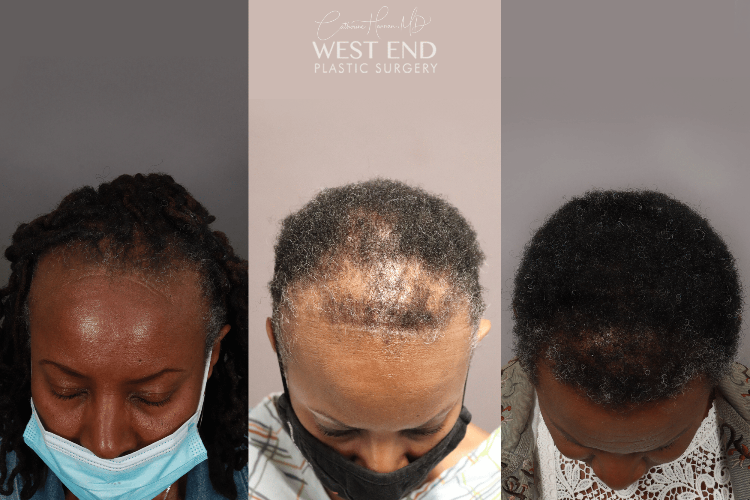 Alopecia Hair Loss Treatment in Washington D.C.