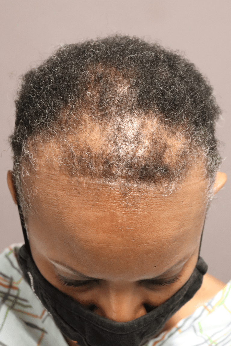 Before Image: Female NeoGraft - front