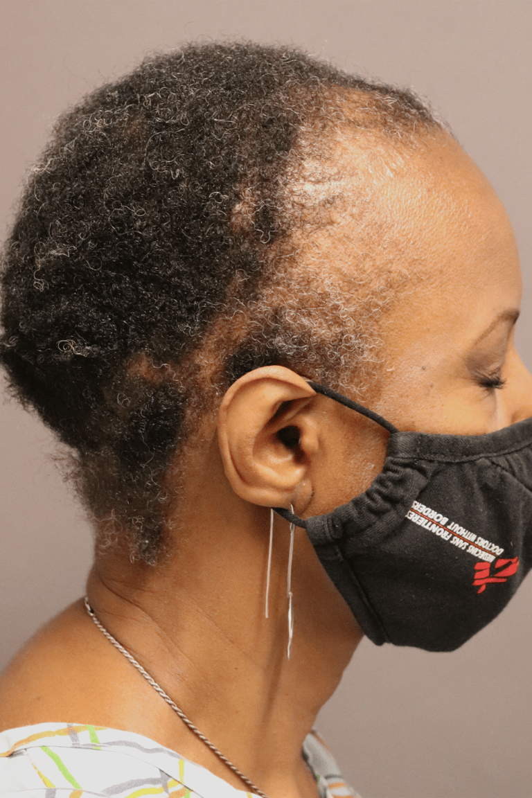 Before Image: Female NeoGraft - left-side