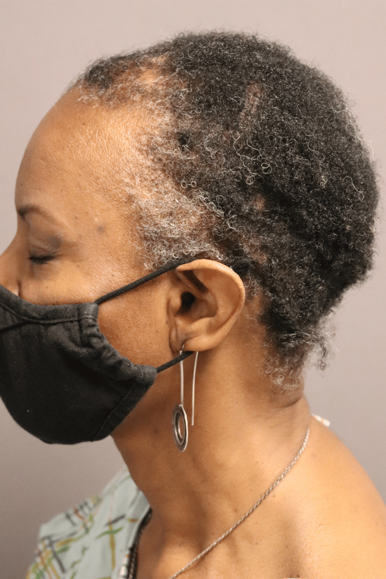 Before Image: Female NeoGraft - front
