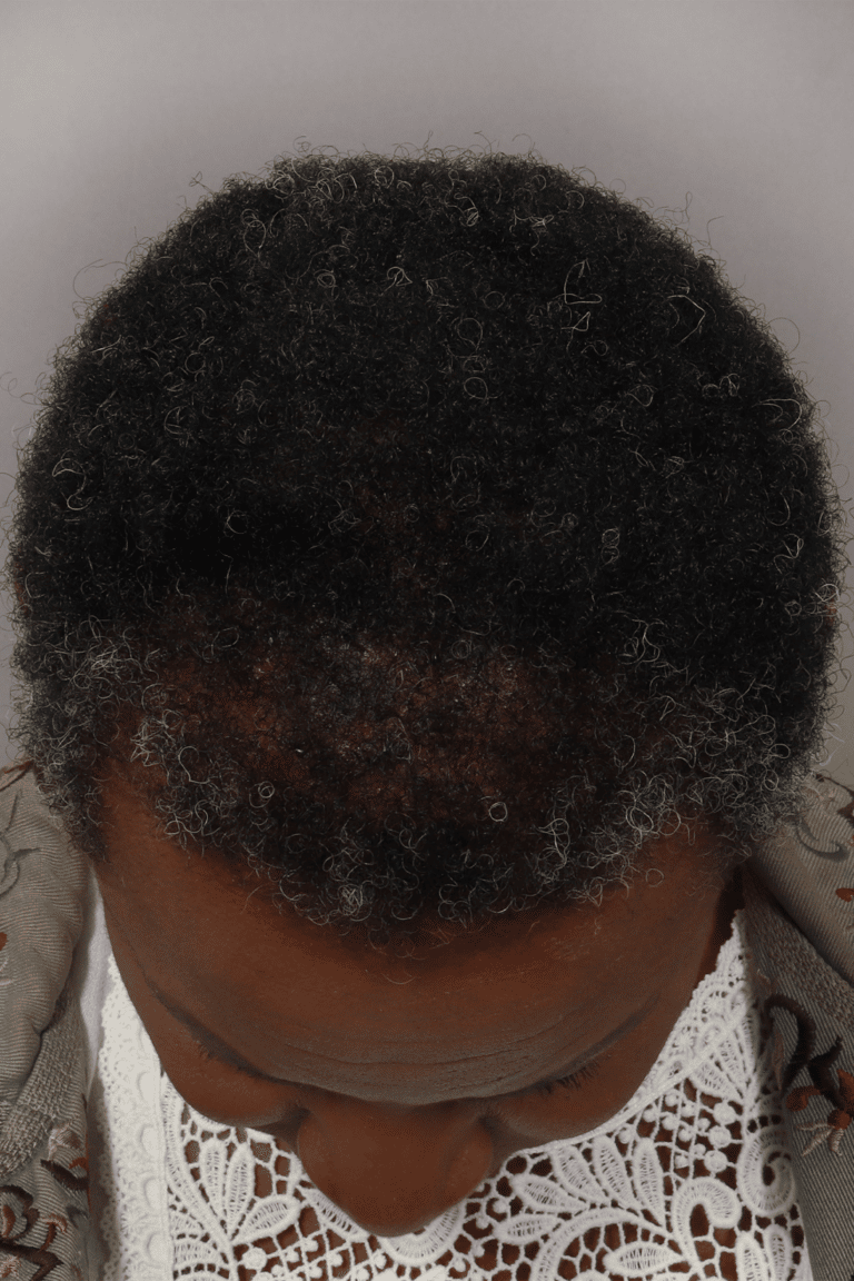 After Image: Female NeoGraft - front