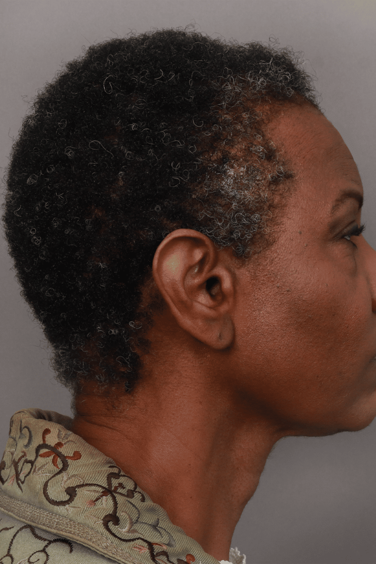 After Image: Female NeoGraft - left-side
