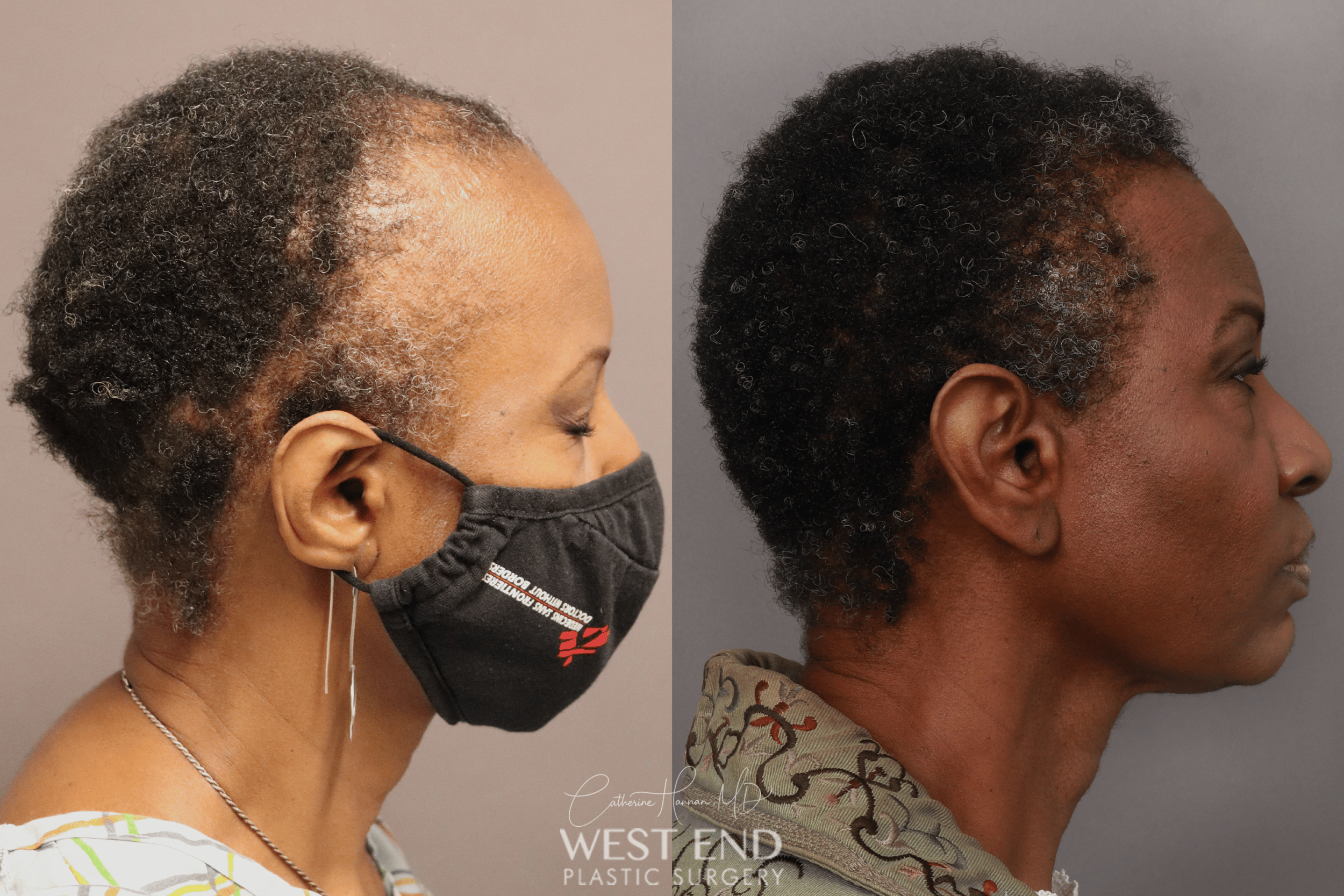 Female Hair Loss Treatment in Georgetown