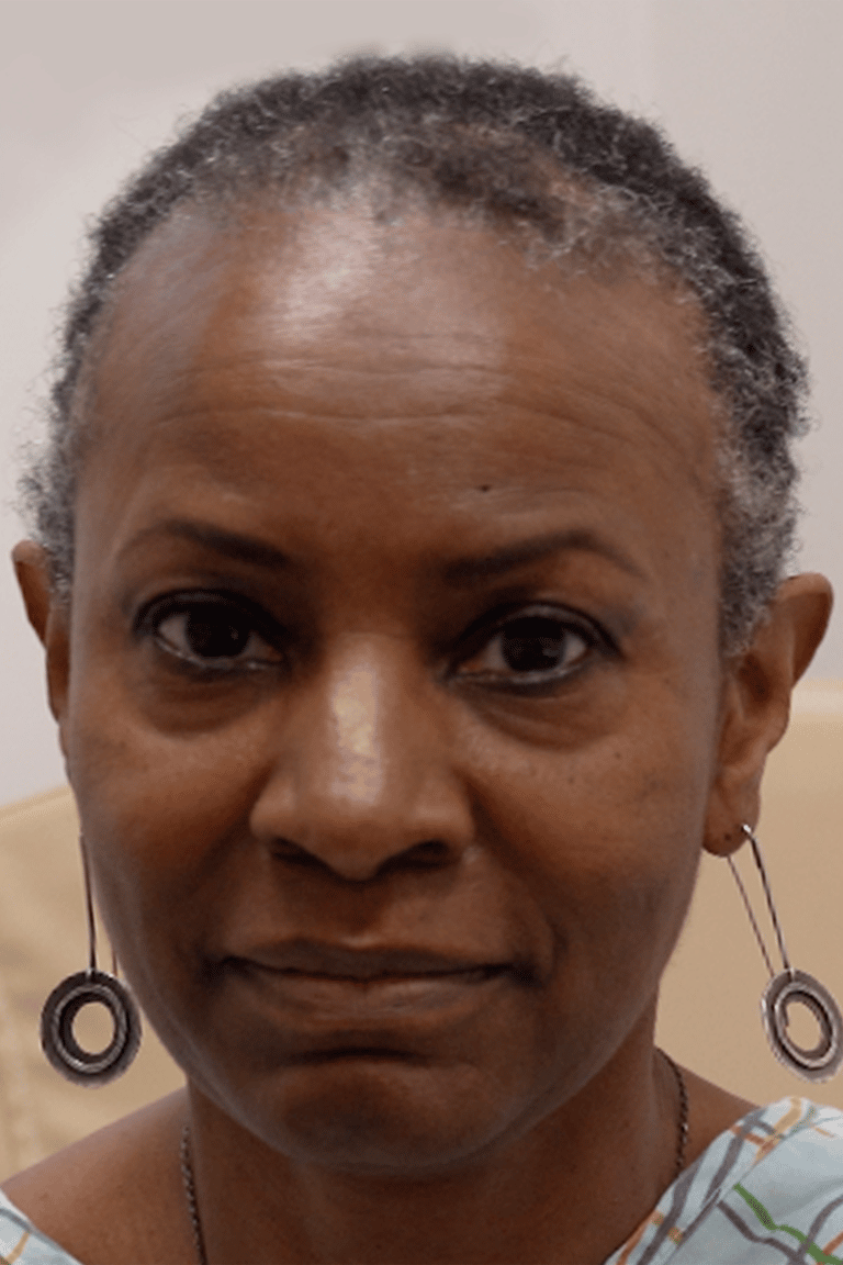 Before Image: Female NeoGraft - front