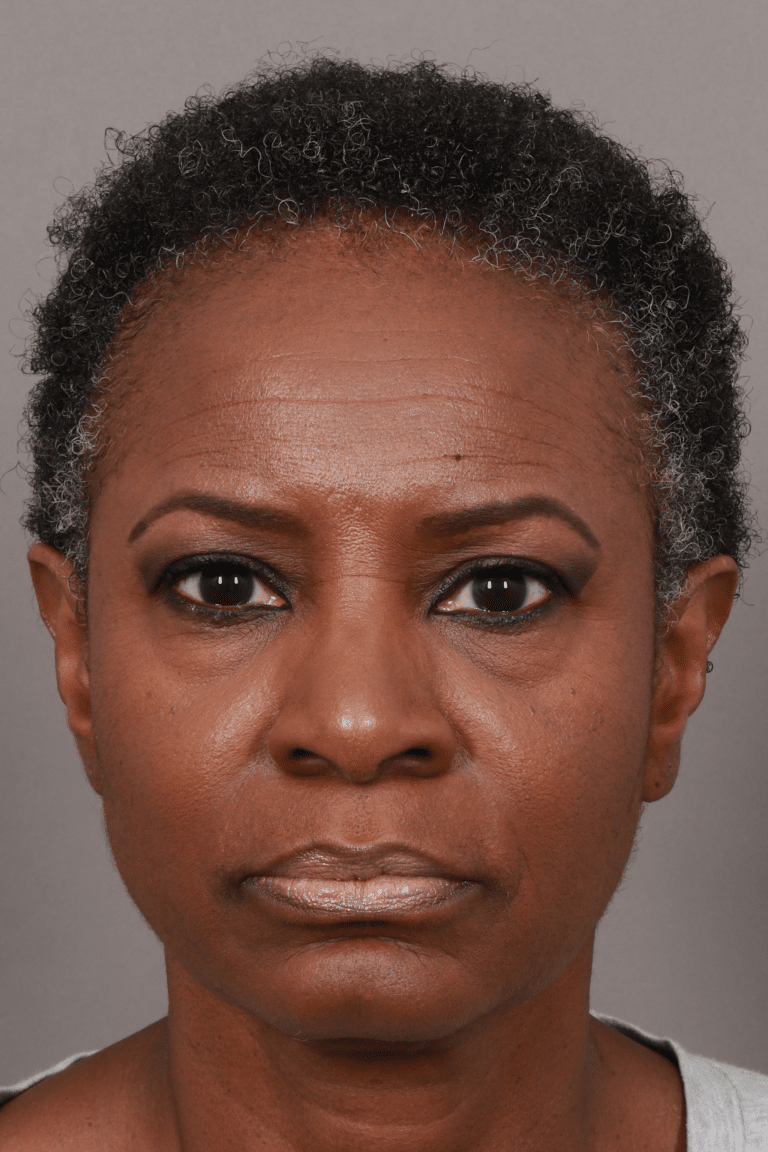 After Image: Female NeoGraft - front