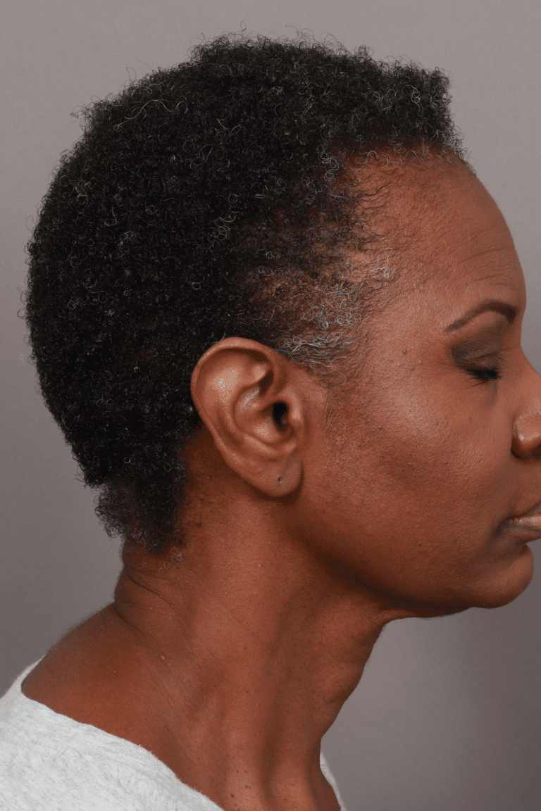 After Image: Female NeoGraft -