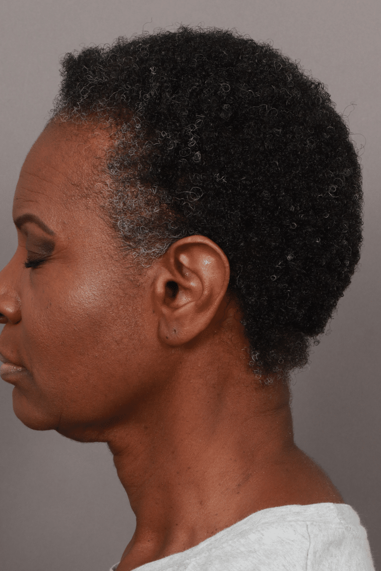 After Image: Female NeoGraft - front