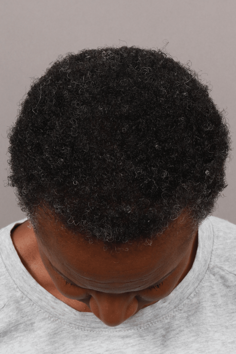 After Image: Female NeoGraft -
