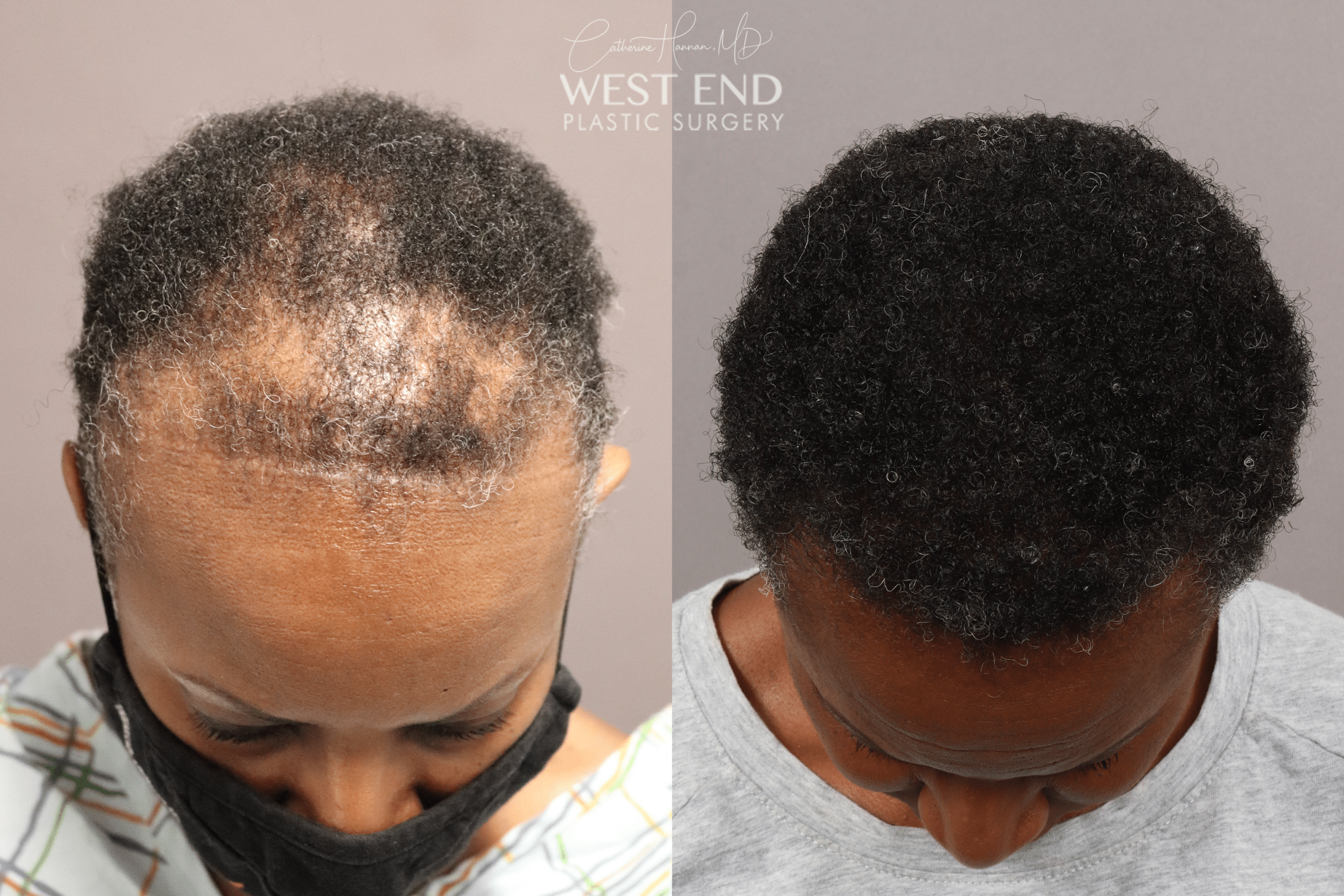 DHI Hair Restoration for Women in Washington D.C.