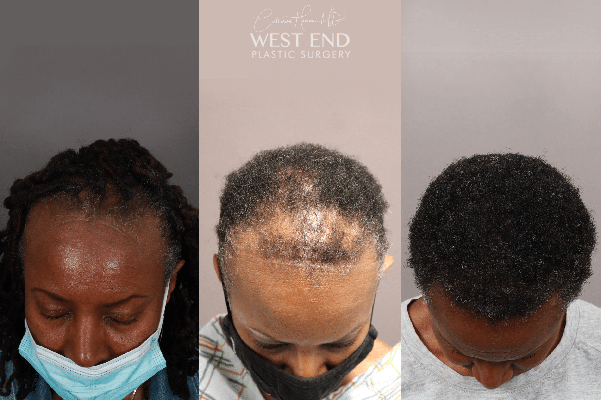 DHI Hair-Transplantation Procedure in Washington D.C.