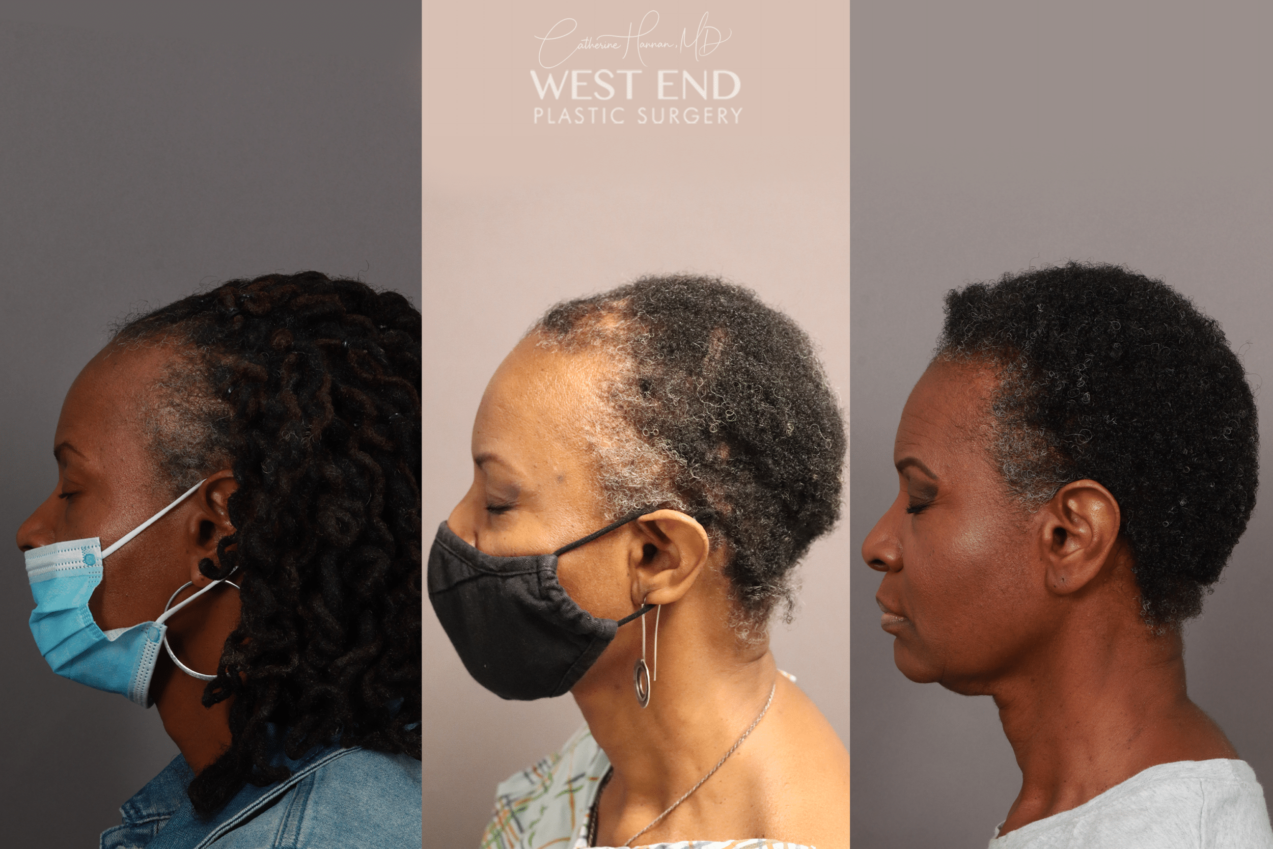 DHI Hair-Transplantation Procedure in Georgetown