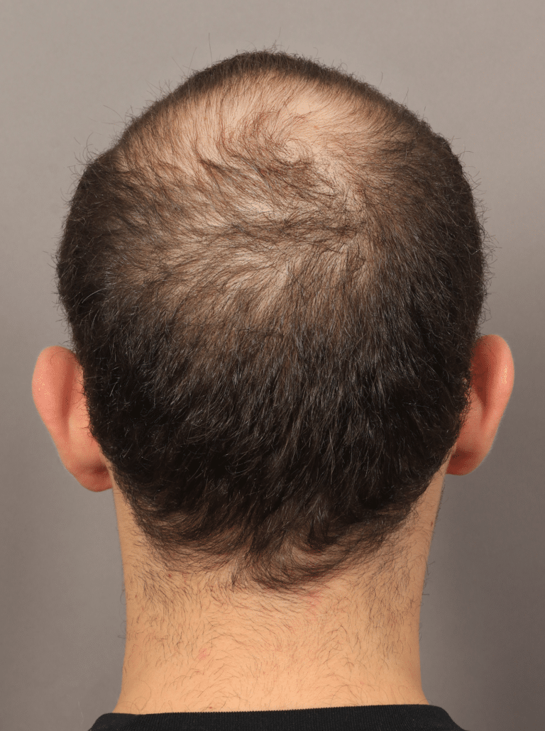 Before Image: Male NeoGraft (7 Months Post-op) - back