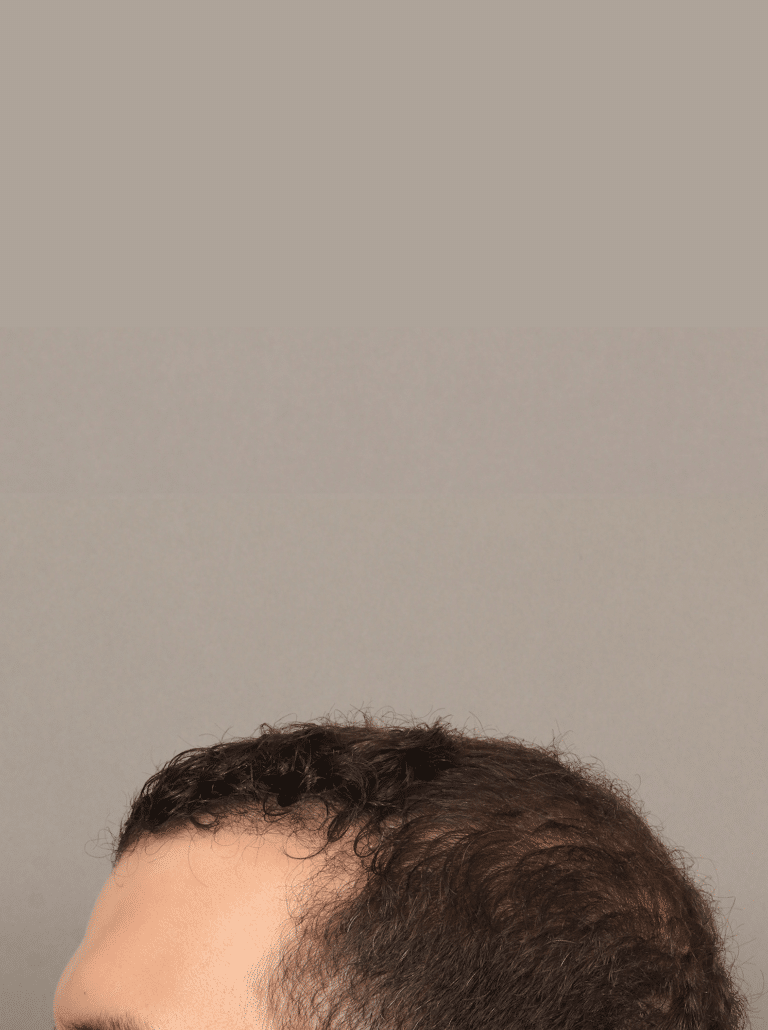 After Image: Male NeoGraft (7 Months Post-op) - left-side