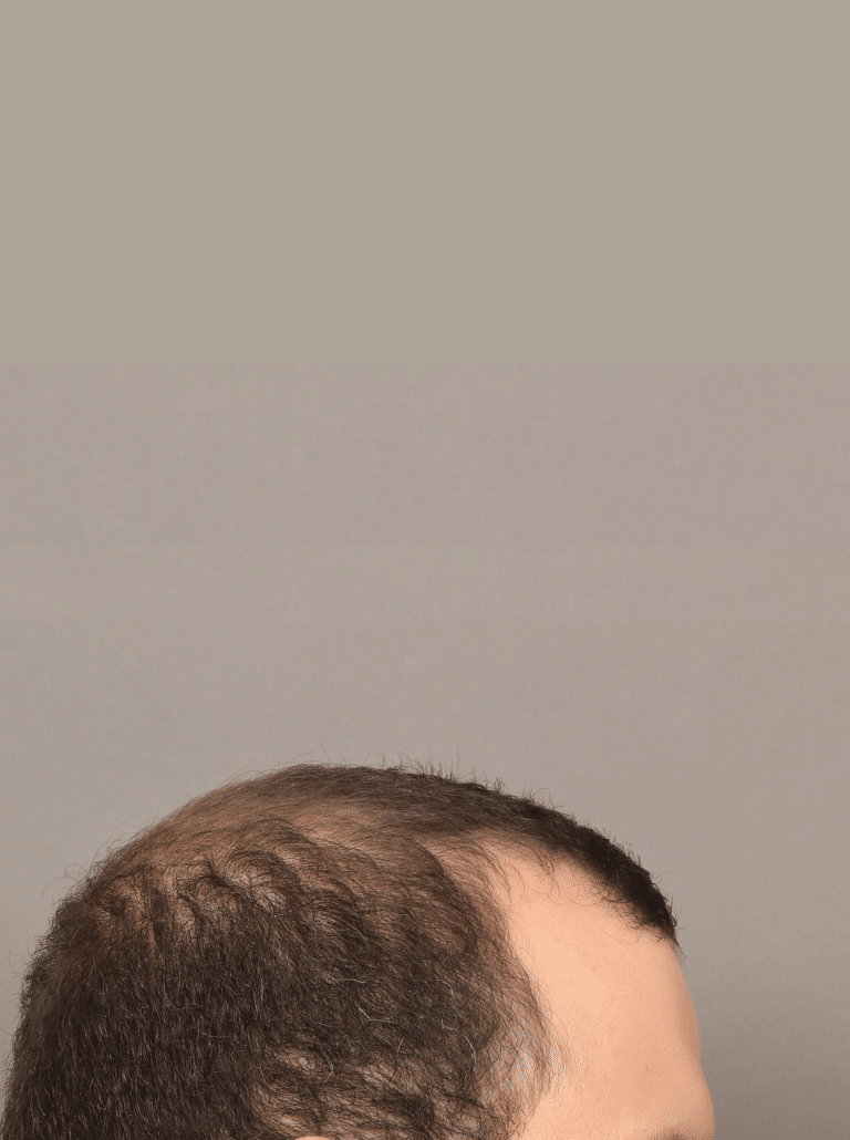 Before Image: Male NeoGraft - right-side