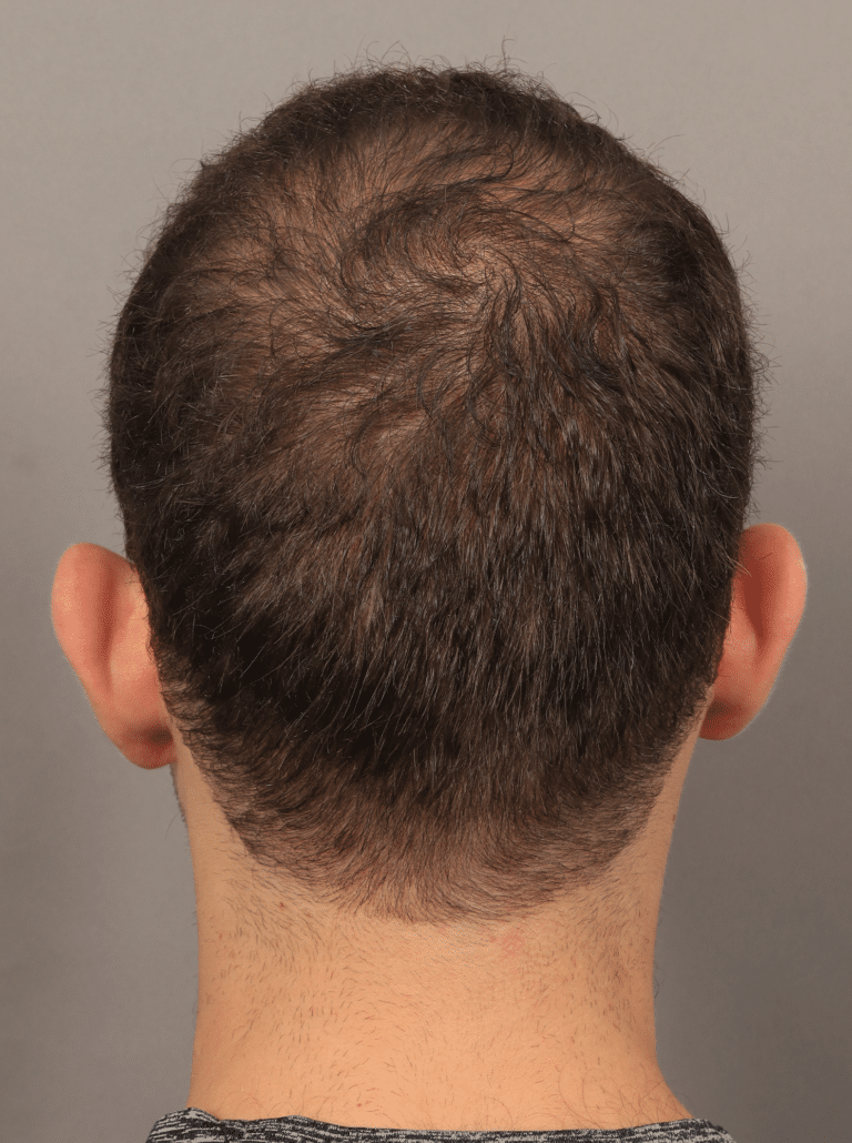 After Image: Male NeoGraft (7 Months Post-op) - back