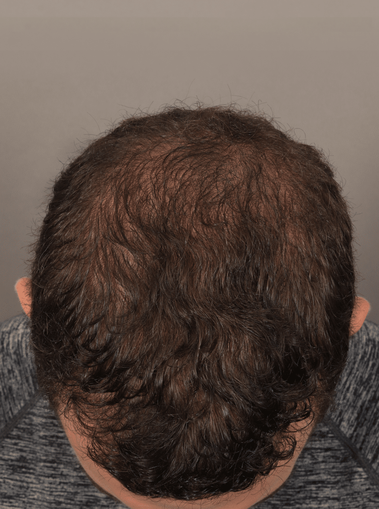After Image: Male NeoGraft - front