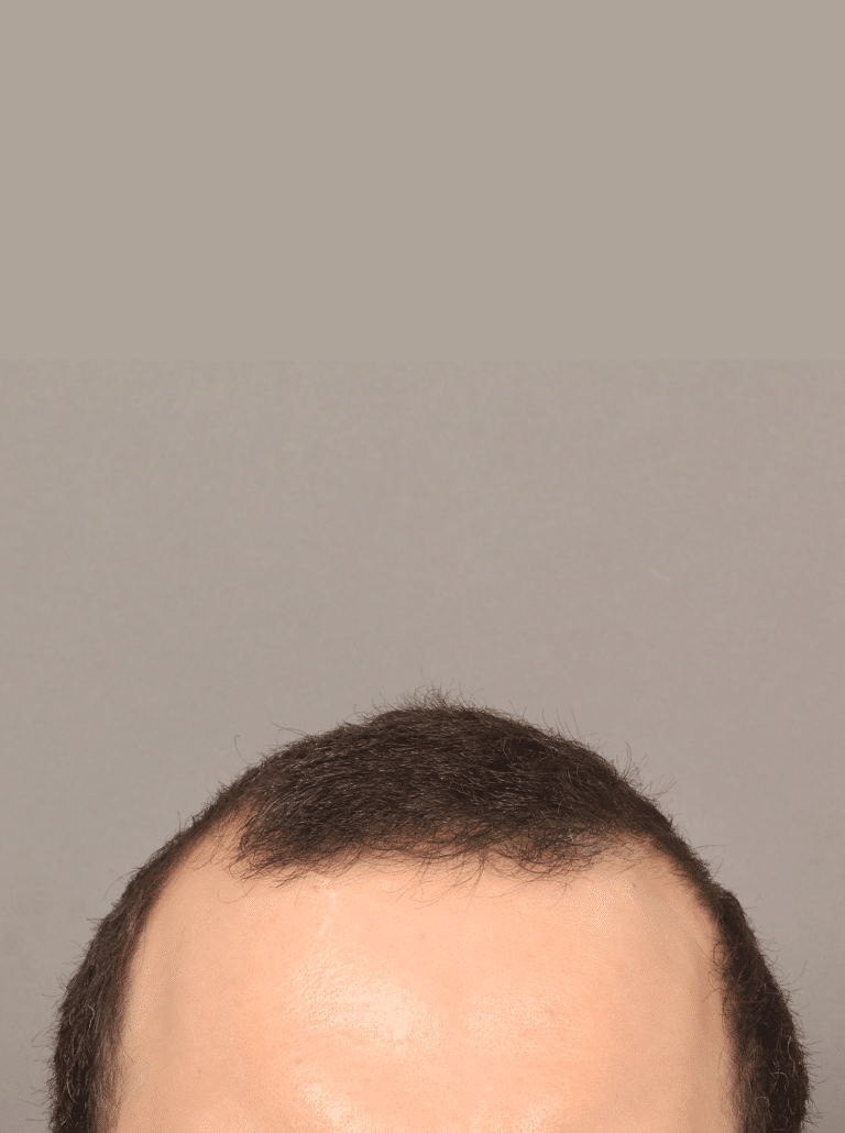 Before Image: Male NeoGraft (7 Months Post-op) - front