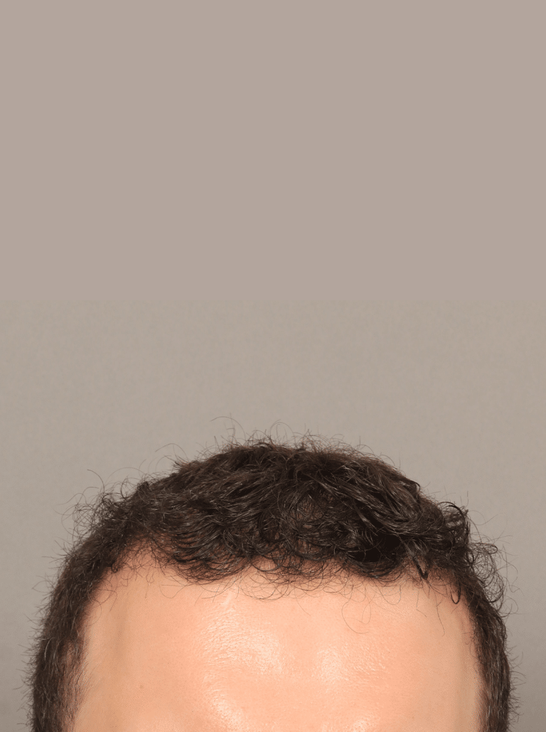 After Image: Male NeoGraft (7 Months Post-op) - front