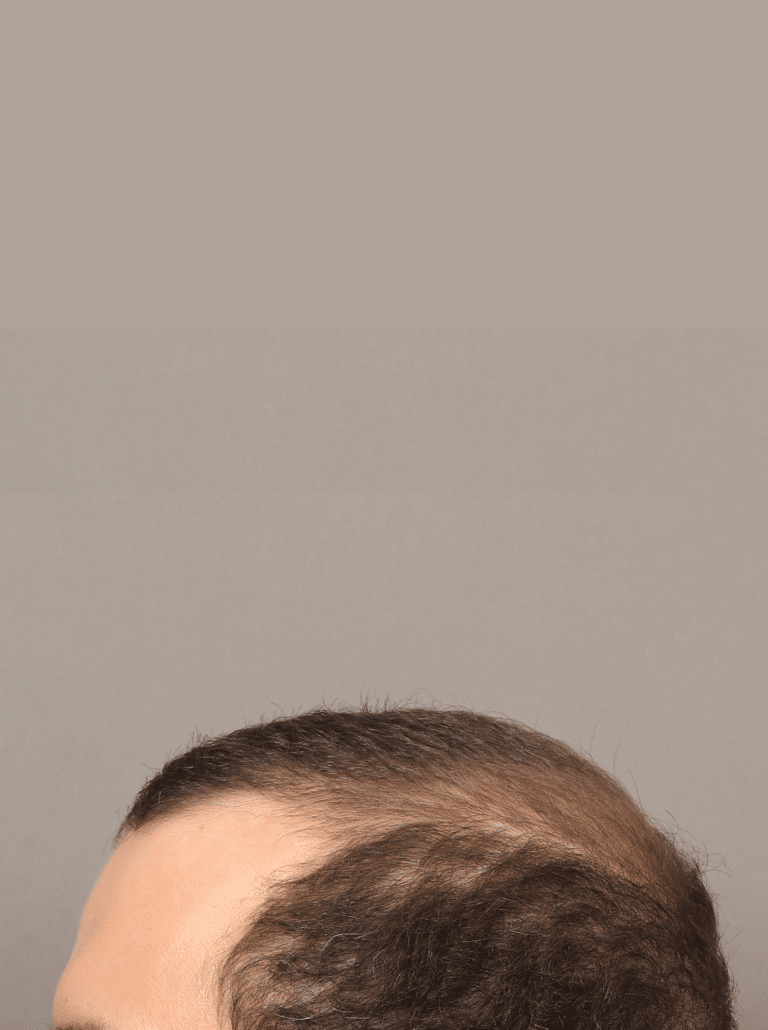 Before Image: Male NeoGraft (7 Months Post-op) - left-side