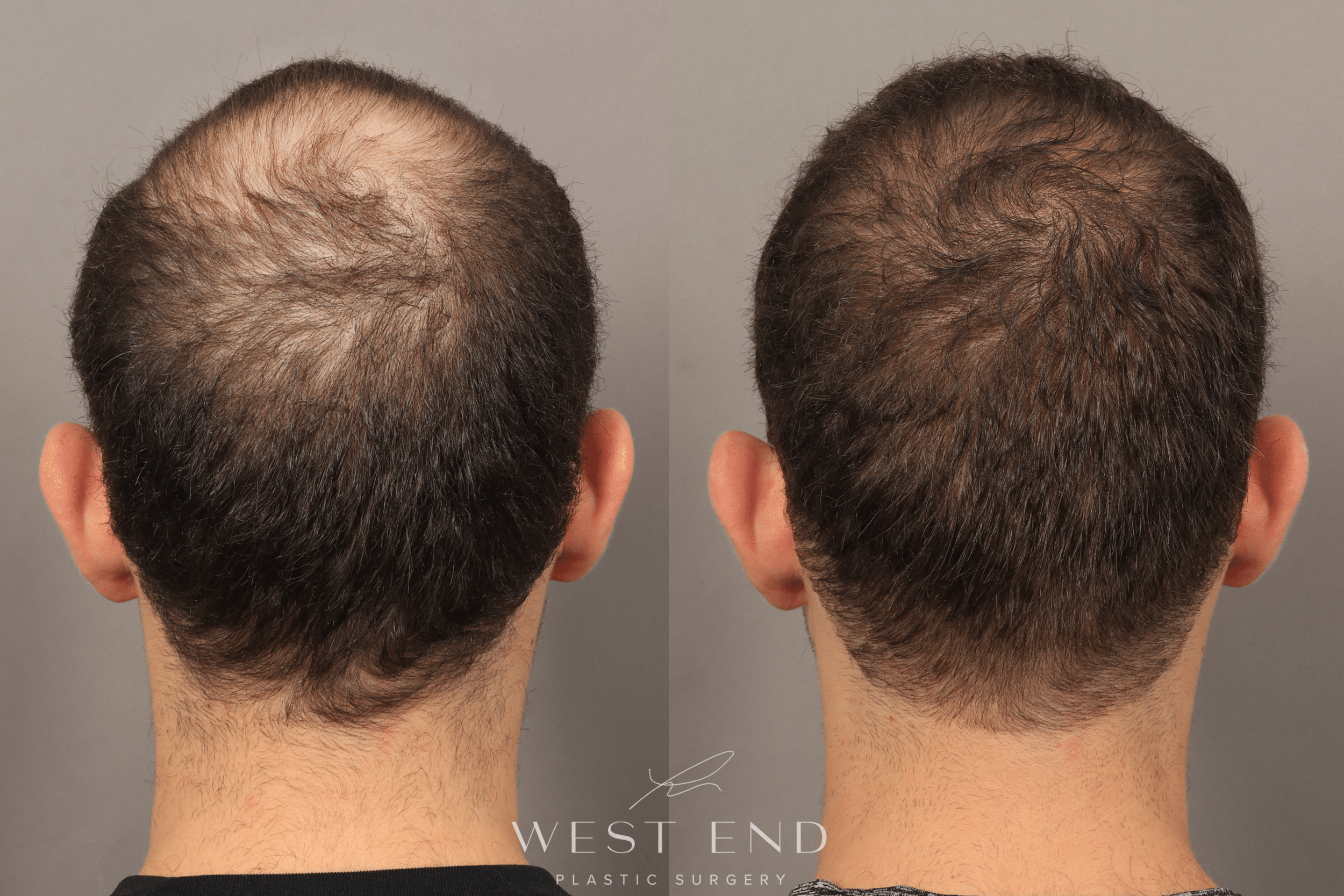 DHI Hair Restoration for Men in Georgetown