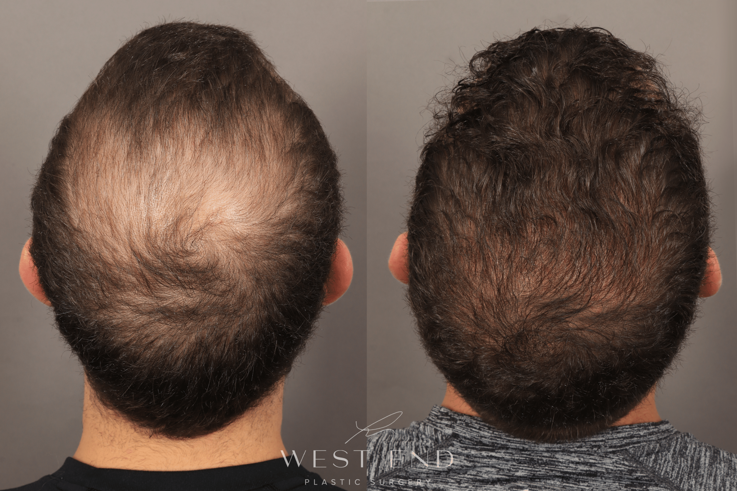 DHI Hair Restoration for Men in Washington D.C.