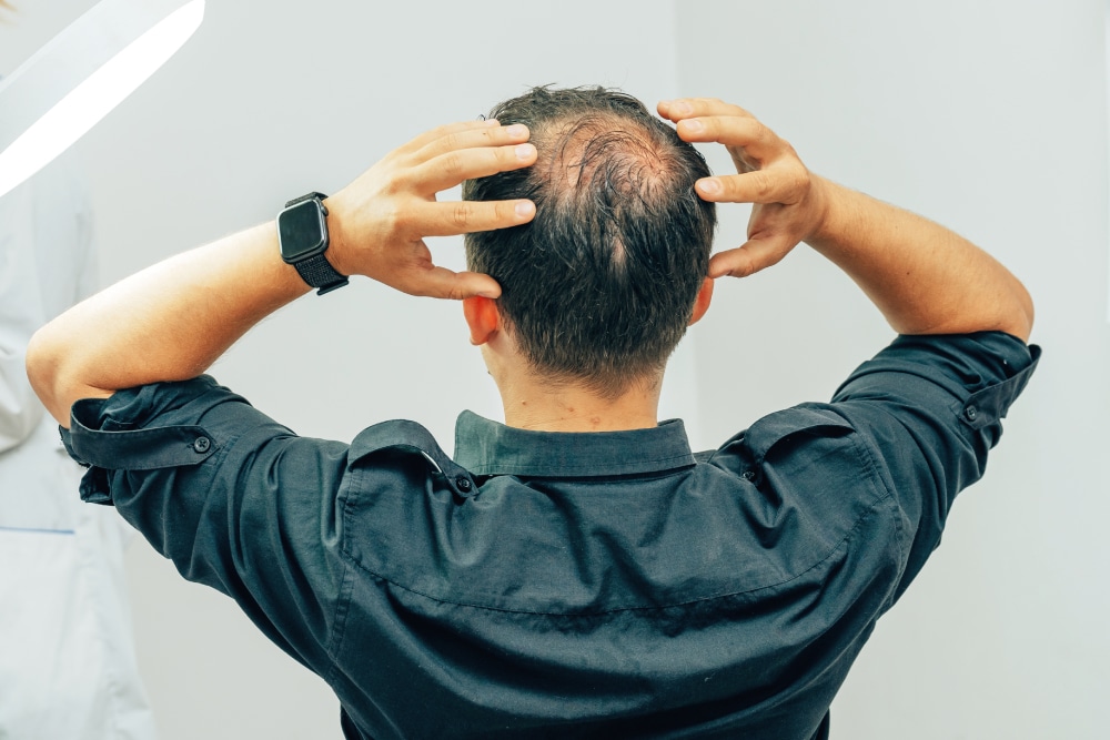 Hair Loss Treatment in Washington D.C.