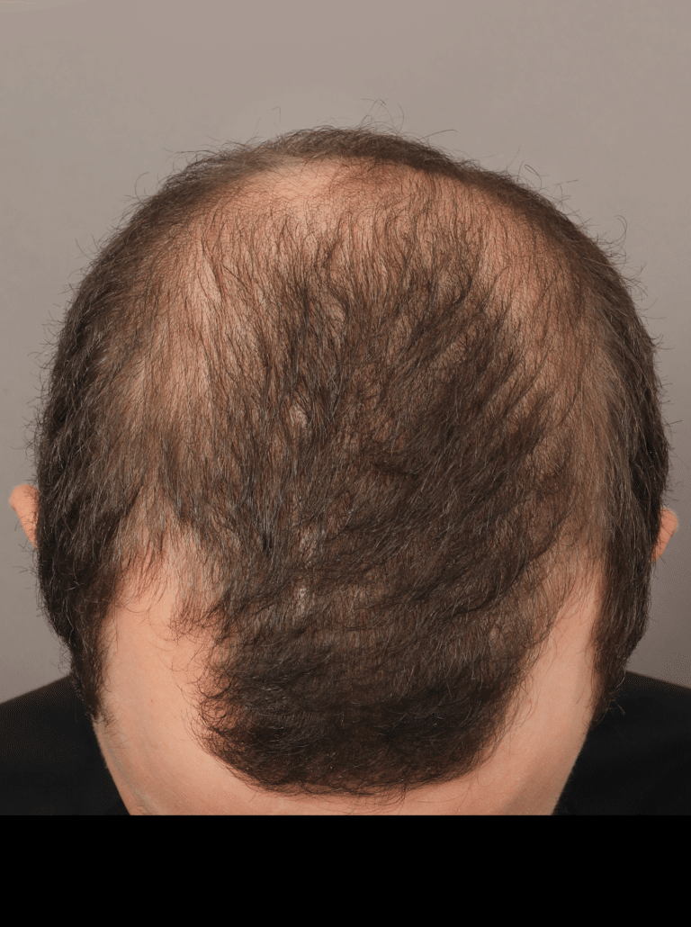 Before Image: Male NeoGraft (9 Months Post-op) - front