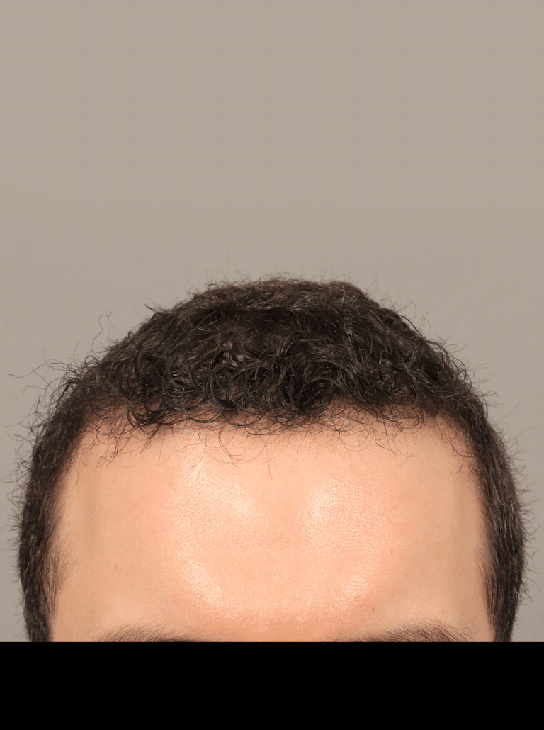 After Image: Male NeoGraft (9 Months Post-op) - front