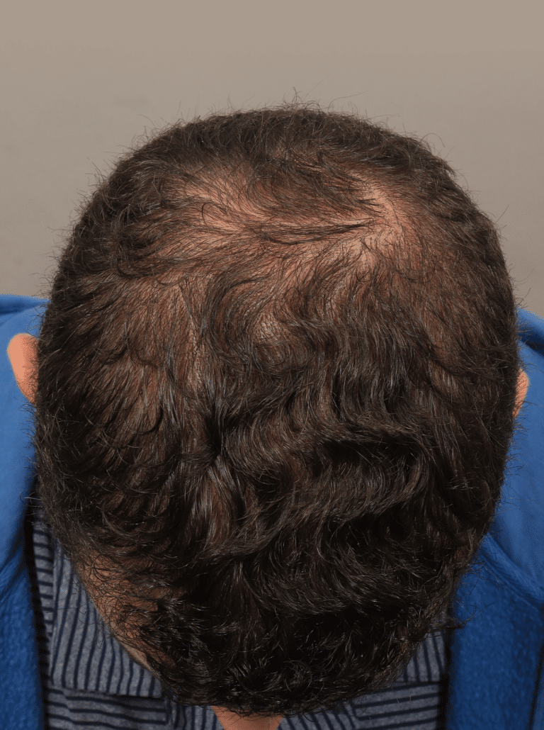 After Image: Male NeoGraft (9 Months Post-op) - front